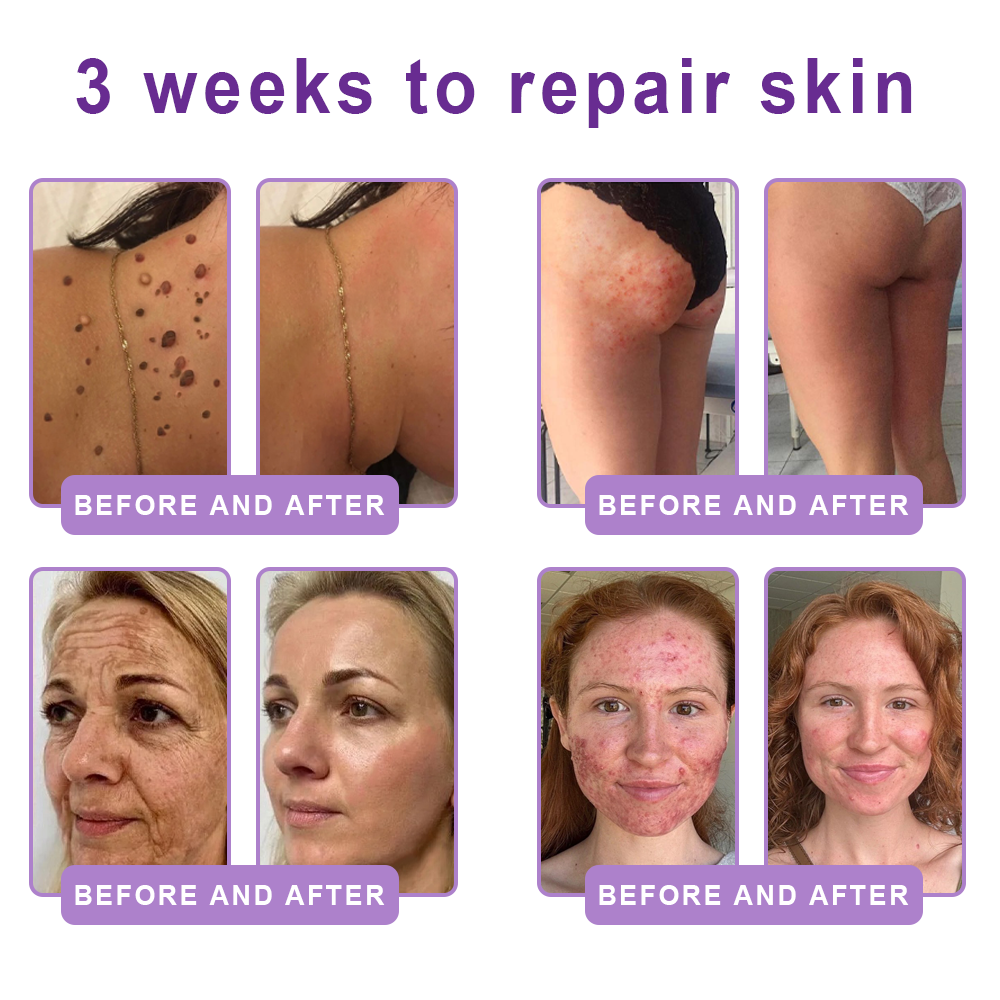 𝐏𝐮𝐫𝐞𝐥𝐨𝐫𝐚® ❤️PDRN Multi-Peptide Massaging Body Roller Cream- Anti-aging, Hydrating, Skin Firming & Lifting, Skin Repair, Even Tone, Acne and Dark Spot Treatment, Wart and Mole Removal, and Psoriasis Relief.