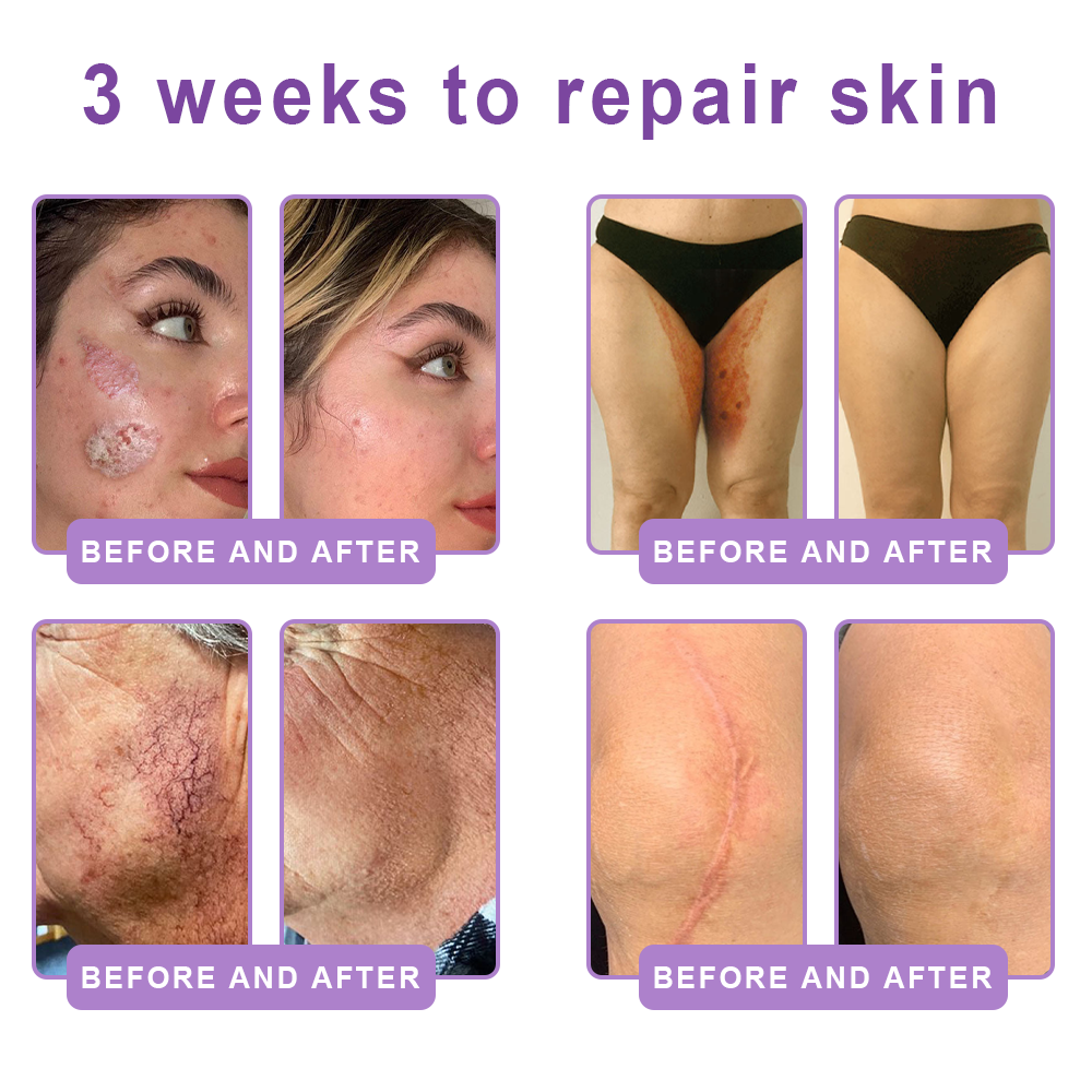 𝐏𝐮𝐫𝐞𝐥𝐨𝐫𝐚® ❤️PDRN Multi-Peptide Massaging Body Roller Cream- Anti-aging, Hydrating, Skin Firming & Lifting, Skin Repair, Even Tone, Acne and Dark Spot Treatment, Wart and Mole Removal, and Psoriasis Relief.
