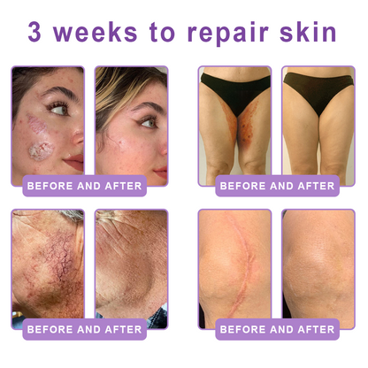 𝐏𝐮𝐫𝐞𝐥𝐨𝐫𝐚® ❤️PDRN Multi-Peptide Massaging Body Roller Cream- Anti-aging, Hydrating, Skin Firming & Lifting, Skin Repair, Even Tone, Acne and Dark Spot Treatment, Wart and Mole Removal, and Psoriasis Relief.